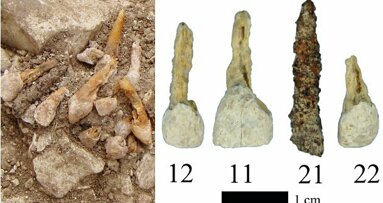 Des archéologues découvrent la plus vieille prothèse dentaire
