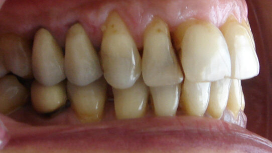 Difetti parodontali: correzioni ortodontiche e chirurgiche