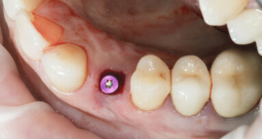 Nanotechnology may improve soft-tissue integration of dental implants