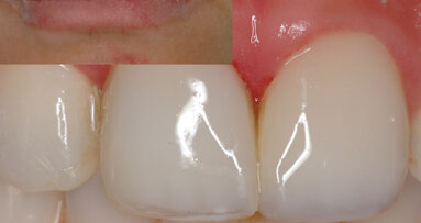 Reconstrucción inmediata de dientes con destrucción avanzada
