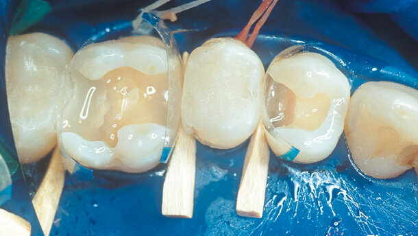 Aesthetic restoration of posterior teeth with composite resins and ceramic inlays
