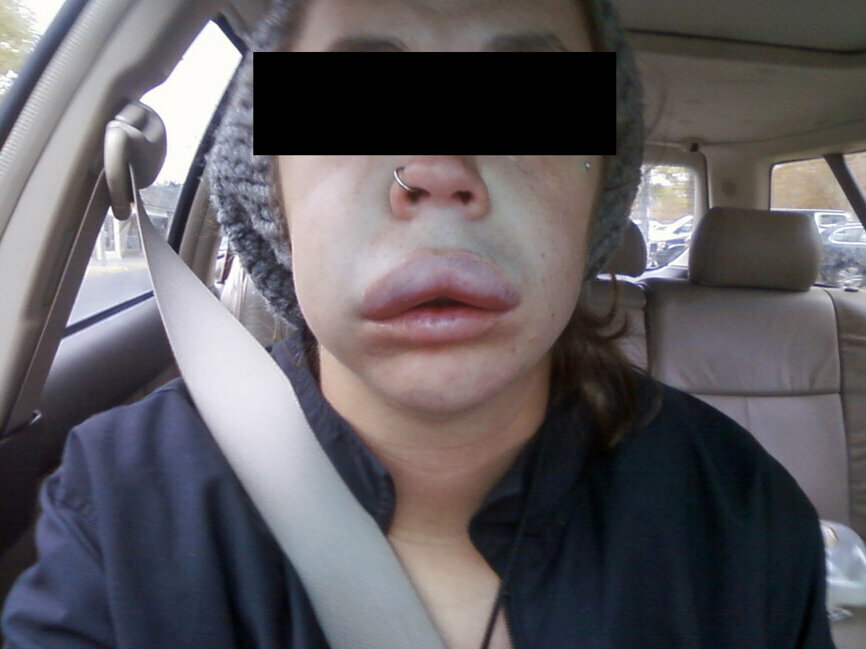 Fig. 1: Sodium hypochlorite accident post operatively, extra oral. (All images provided by Brett Gilbert, DDS, and Richard Mounce, DDS)