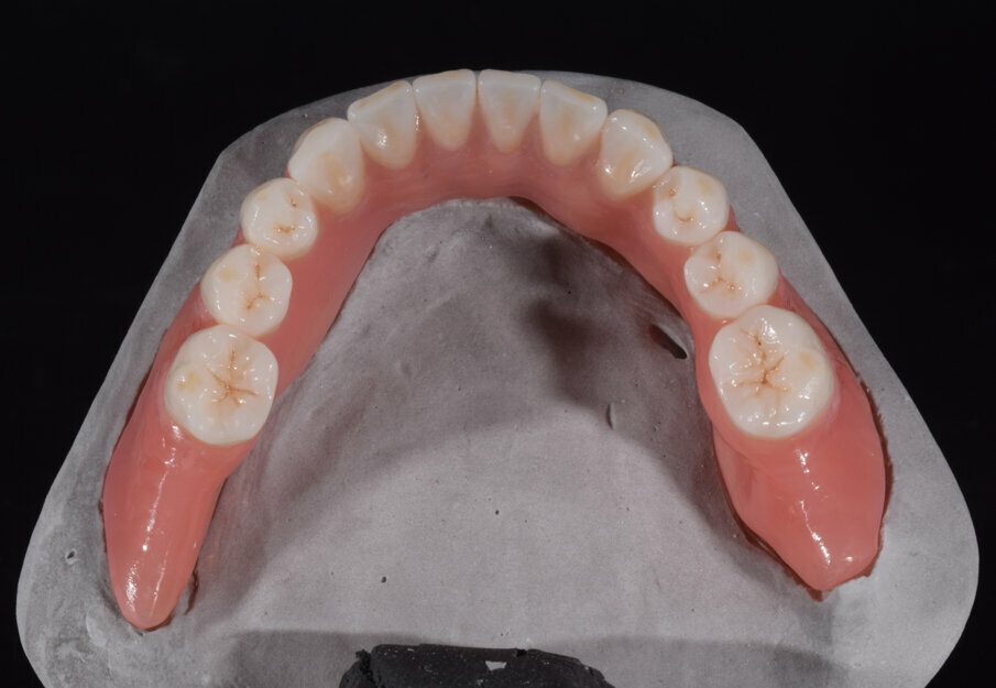 Fig. 19: Individualisation of the occlusal surfaces of the mandibular denture with composite stains (FinalTouch).