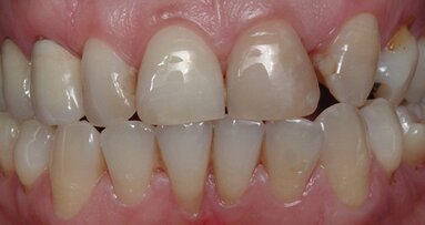 Rehabilitación bucal estética con asistencia de ortodoncia