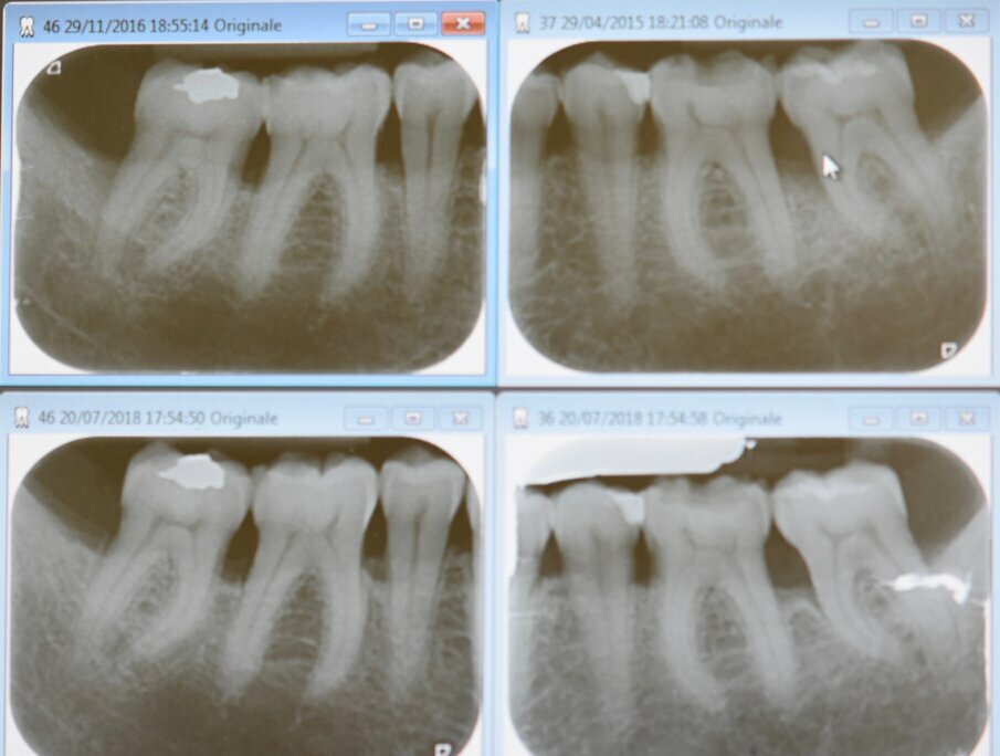 Fig. 1 - Miglioramento dei siti trattati con TPNC evidenziabile attraverso l’RBL (Radiographyc Bone Loss) in un paziente con parodontite di Stadio III e Grado A.