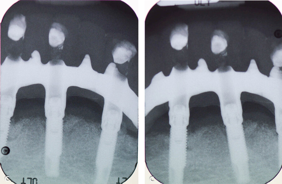 Figure 5. Post-op radiographs at 3 months after therapy.