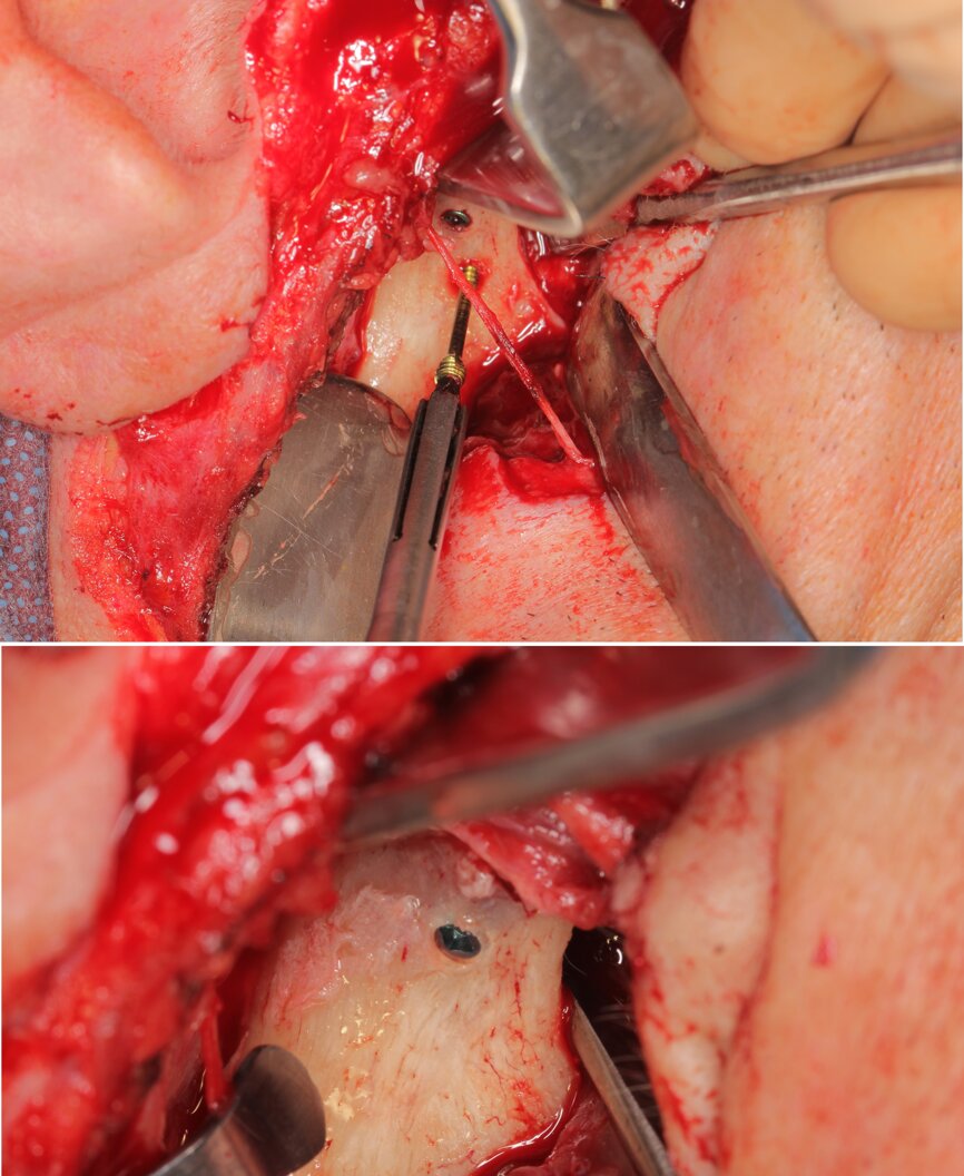Ryc. 5_Zdjęcia śródoperacyjne – zabieg otwartej repozycji i osteosyntezy złamania głowy żuchwy strony prawej.