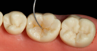 Four questions on current trends in direct posterior and anterior restorations
