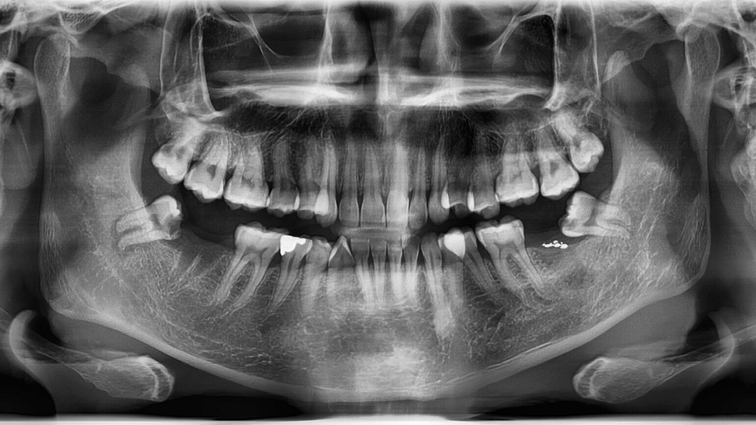 Age assessment using molars debunked