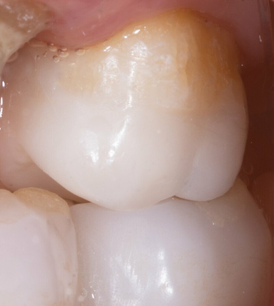 Fig. 19: Clinical result after cementation. 