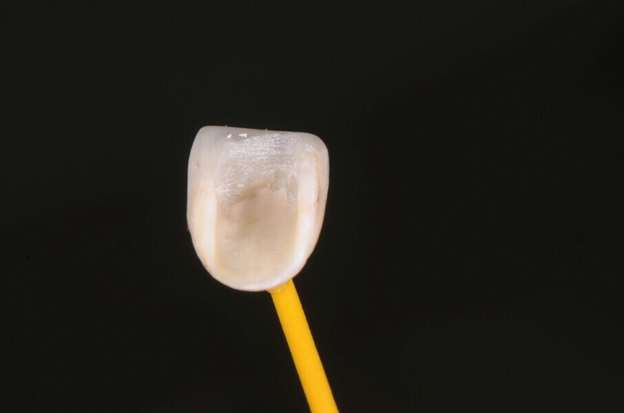 Fig. 14a : Un pilier provisoire (b) est fabriqué au moyen de la coquille reproduisant la face vestibulaire de la dent extraite (a). 