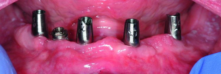 Fig. 12: Atlantis Conus Abutments seated. Note the “margins” of the abutment, and the point where the parallel preparation begins, is supra-gingivally positioned.
