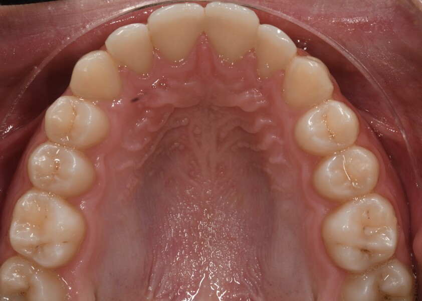Fig. 20: Final intra-oral photograph. 