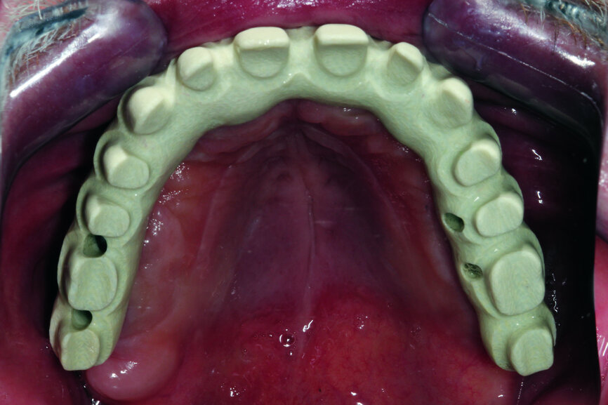 Fig. 12: Test of the construction within the oral cavity—visible opening for screws.