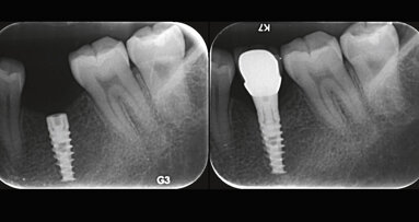 Low implant insertion torque allows minimal bone loss: A multicenter two-year prospective study