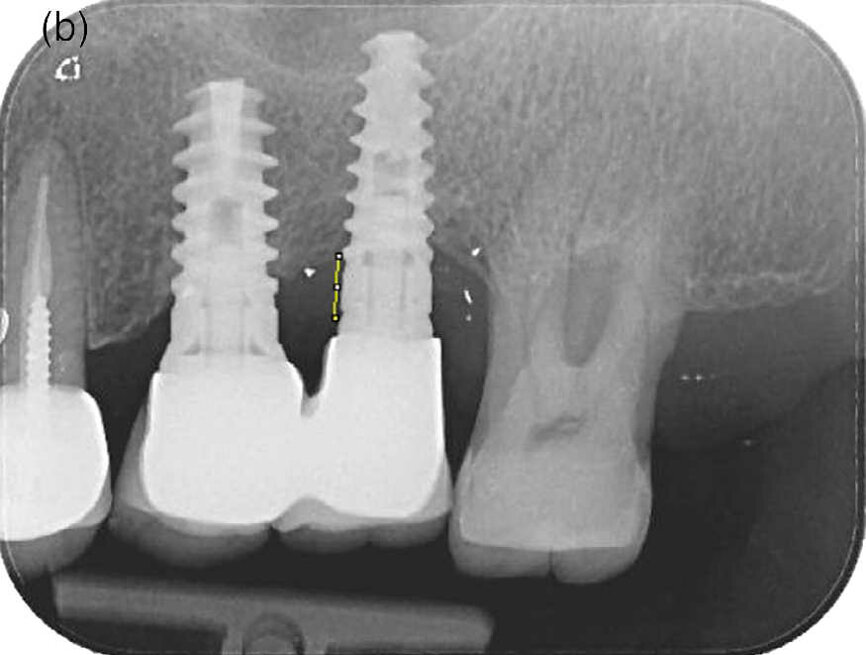 Fig 2(b) Radiographie 12 mois après le traitement (groupe P).