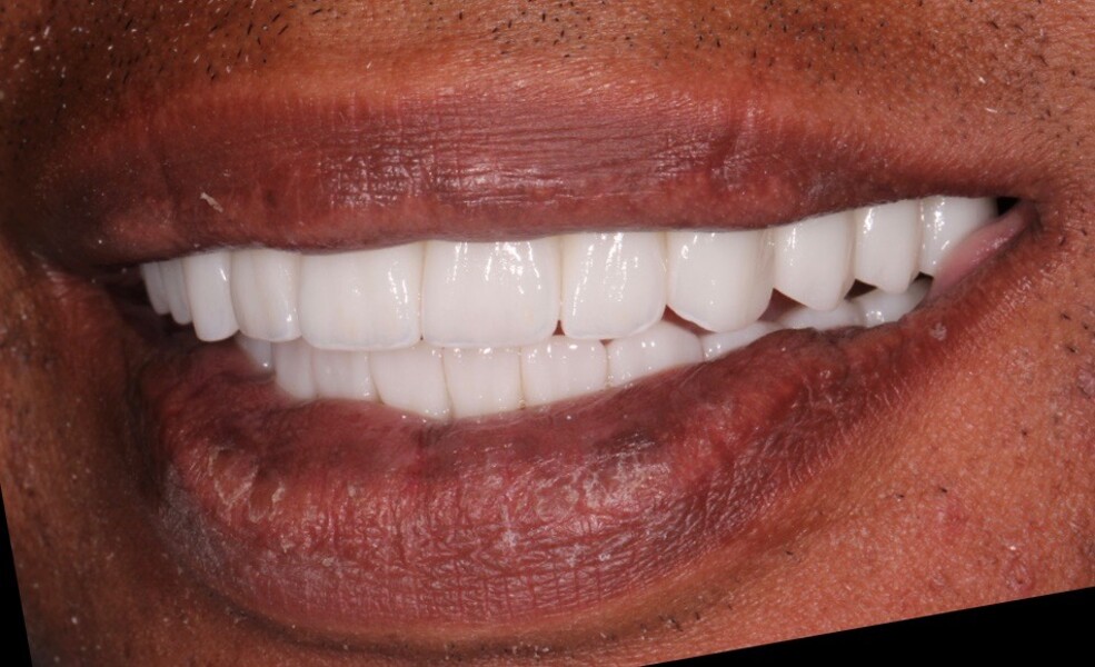 Fig. 29: Left lateral view of the patient’s smile.
