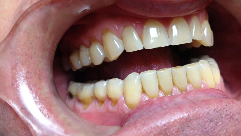 Research examines link between tooth wear management and quality of life