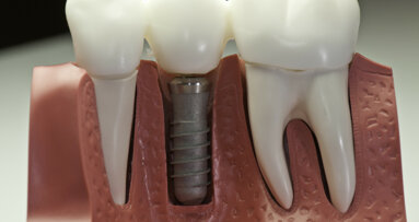 Heeltijd dentale implantaten kan omlaag