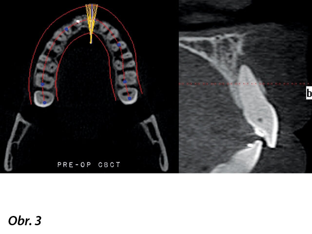 CBCT snímek ukazuje těžkou kalcifikaci kořenového kanálku a apikální obraz odpovídající apikální periodontitis.