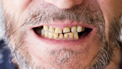 Pandemia causando aumento nas condições de saúde bucal relacionadas ao estresse