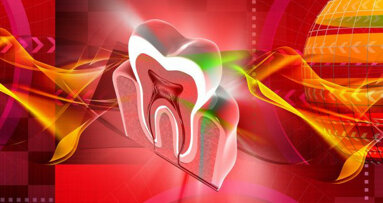Zubi otporni na kvarenje: molekul nazvan „Keep 32“ uništava bakterije koje mogu uzrokovati karijes