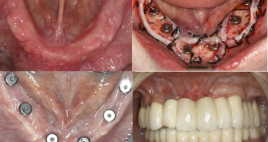 Nuevos métodos para obtener encía queratinizada alrededor de los implantes dentales