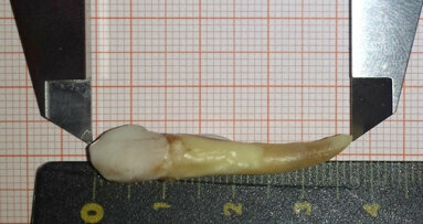New world record: German dentist extracts world’s longest human tooth