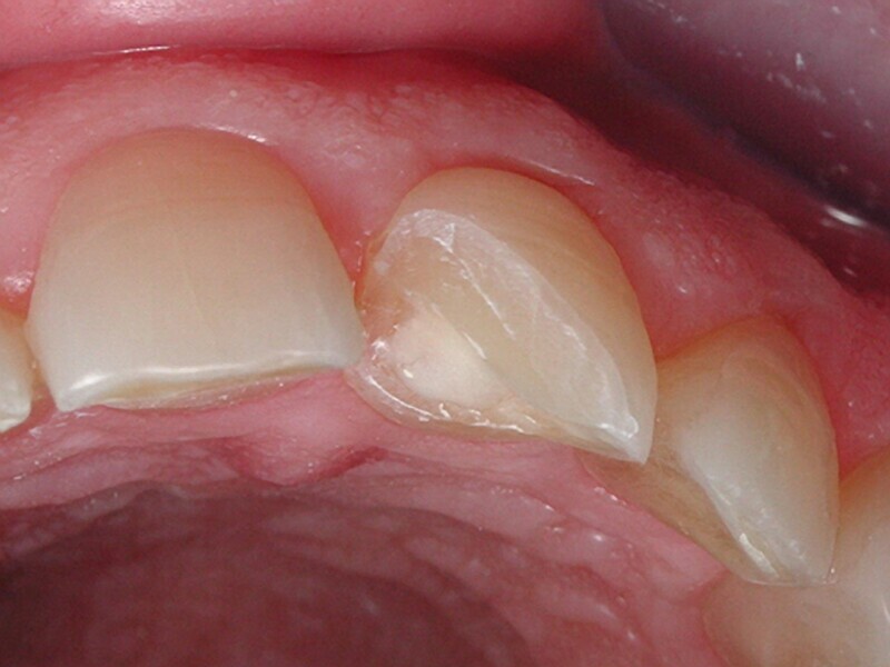 Figura 2. Protegiendo dentina con ionómero de vidro fotopolimerizable.