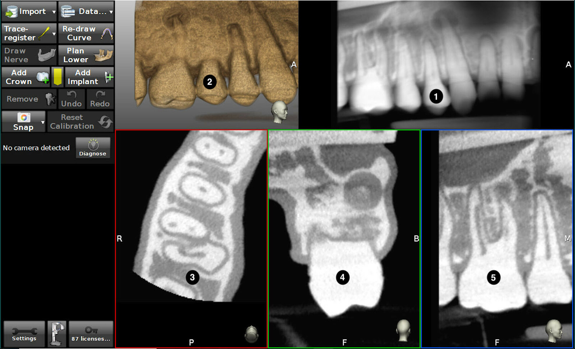 Dynamic navigation—The future of minimally invasive endodontics