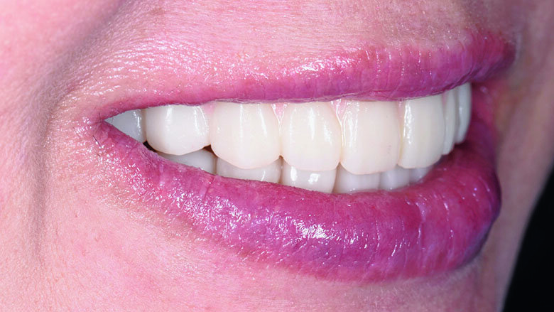 Fig 25. Post-operative smile with provisional profile prosthesis