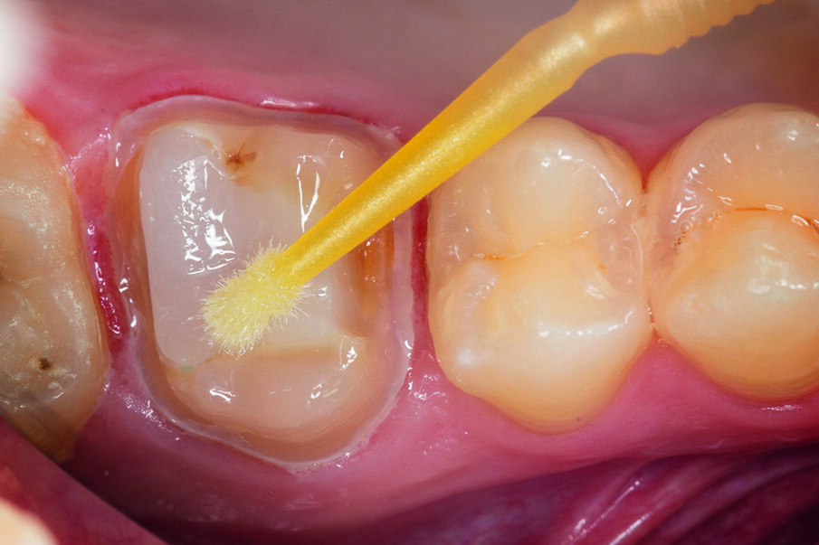 Fig. 10: After having etched tooth surfaces, Prime&Bond® universal was applied and dried. 