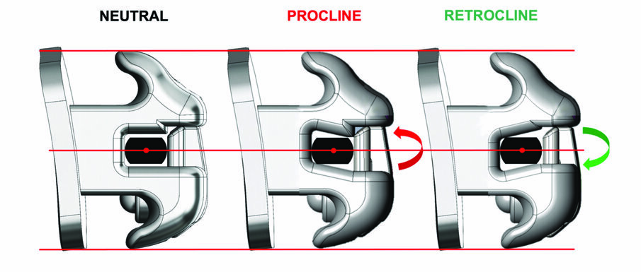 Fig. 1. The parallelogram slot of the procline and retrocline brackets provide level slot alignment when variable torques are placed on adjacent teeth. The torque in slot design allows for ample tie wing space.
(Photos/Provided by Dr. Tom Barron & Ormco)