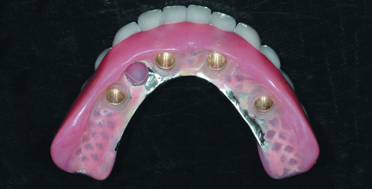 Fig. 15: Completed bridge with SynCone caps processed in position. Because they have been processed intraorally, there is no error in fit, these caps are extremely retentive allowing only vertical displacement of the prosthesis.