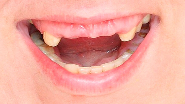 La perdita dei denti potrebbe rallentare le funzioni del corpo e della mente