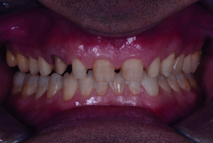 Fig. 8 : Aucune préparation des dents postérieures et seulement une préparation minimale des dents antérieures inférieures. Les dents 11-13 et 21-23 avaient déjà été préparées.
