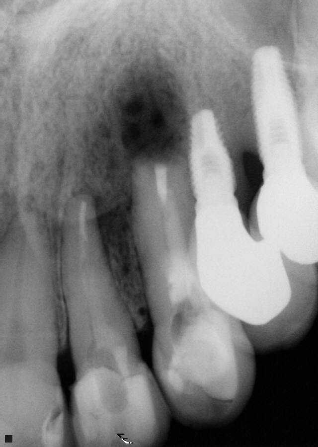 Fig. 4: Periapical radiograph during the root-end surgery verifying the complete root-end filling.
