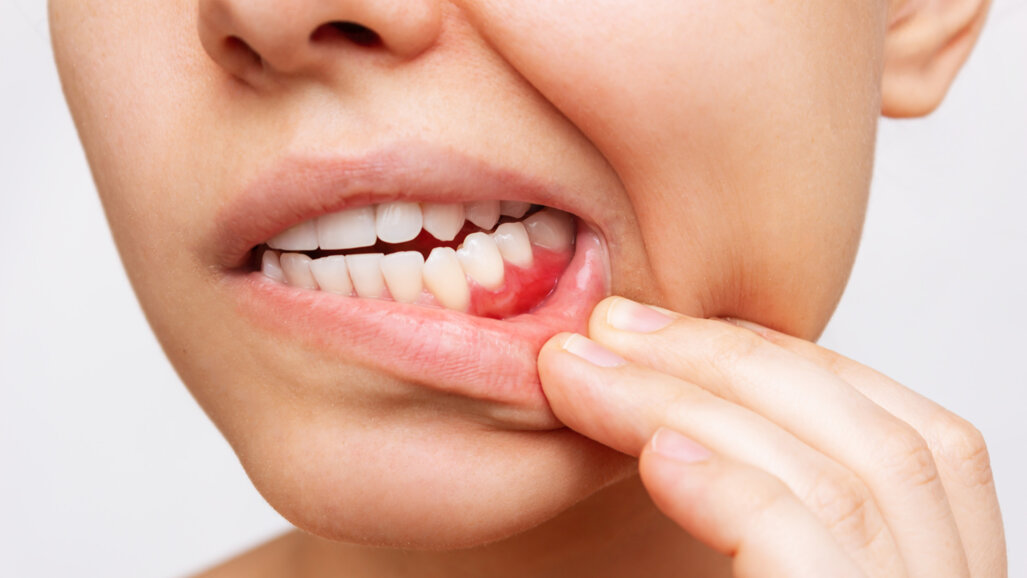 Tratamento periodontal ineficaz para fumantes inveterados com periodontite grave, segundo estudo