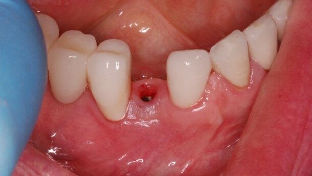 Komplikacje implantoprotetycznej rekonstrukcji braków zębowych – opis przypadku