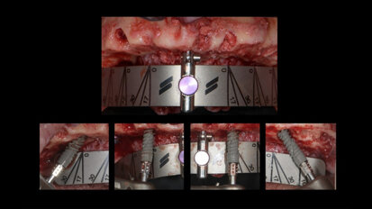 How guided implant surgery facilitates communication and the treatment decision process