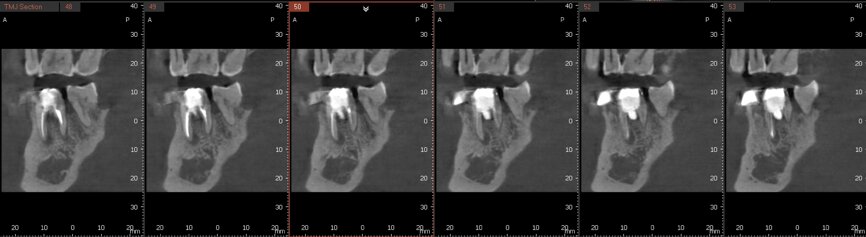 Fig. 6b: Post-op CBCT images of tooth #46 showing adequately obturated canals at all levels to the working length and sealing of the furcation defect.