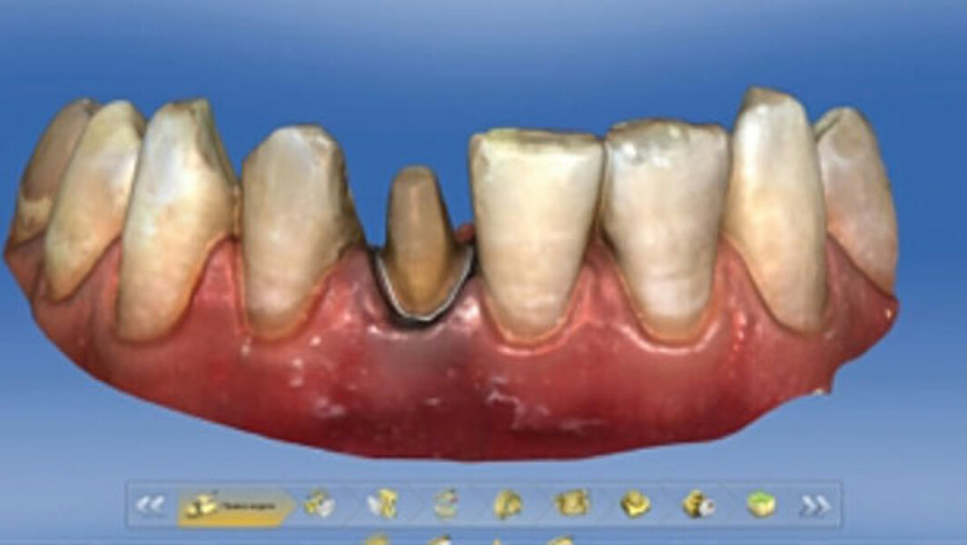 Fig. 7. También para la preparación de la corona completa en el diente 41 se estableció digitalmente el límite de la preparación.
