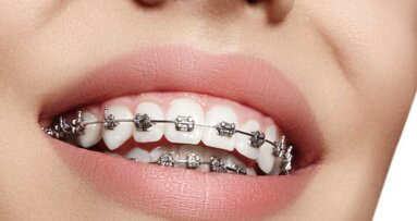 Nieuw adhesief voorkomt cariës rond orthodontische brackets
