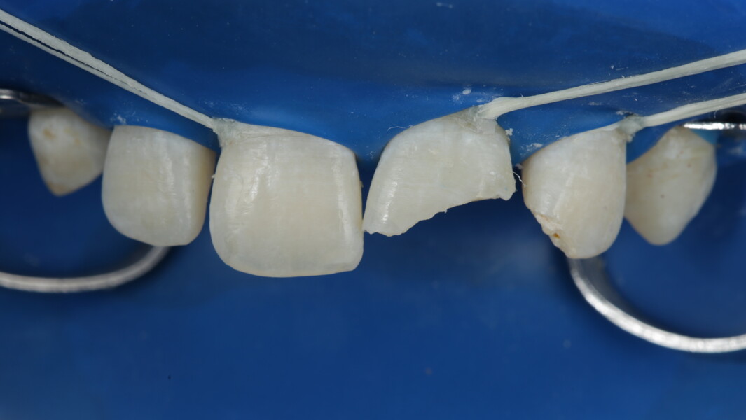 Fig 8: After thorough prophylaxis, the concerned site was isolated with a rubber dam and further retraction of gingiva was achieved with the help of floss ties. 