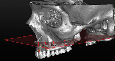 Studio radiologico sulla variazione anatomica delle altezze dei mascellari superiori nelle diverse classi scheletriche