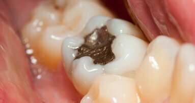 A redução de amálgamas dentárias endossada pela UE entra em vigor