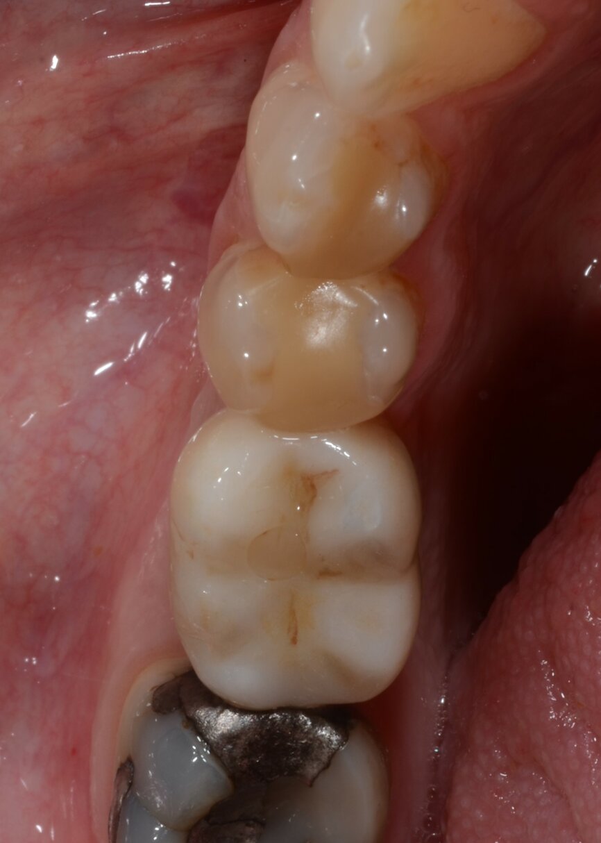 Fig. 20: One-year follow-up occlusal view.