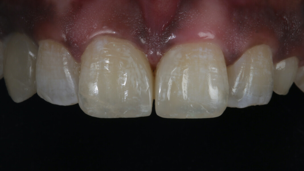 Fig 24. The white opaquer used just under the enamel layer blended well with the rest of the hypoplastic lines even after rehydration.