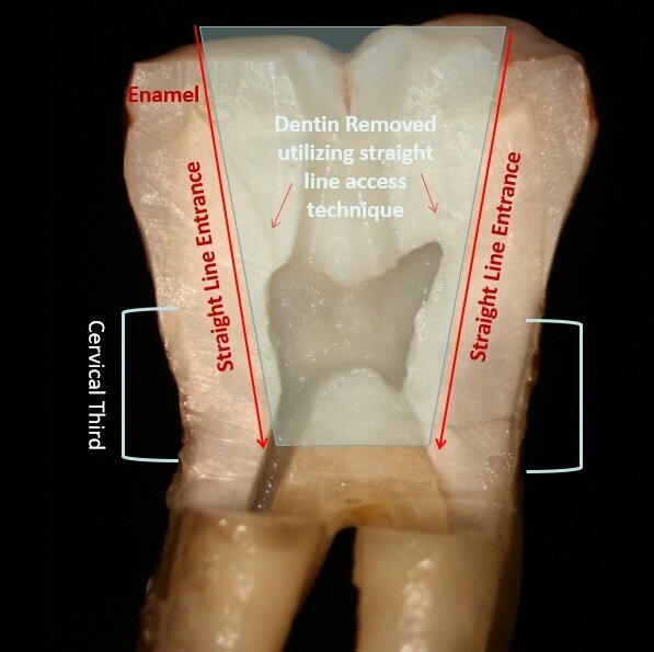 Fig. 2: Traditional endodontic access with an attempt at straight line entrance into the canal orifice typically follows a vertical path necessitating more coronal tooth structure removal. 