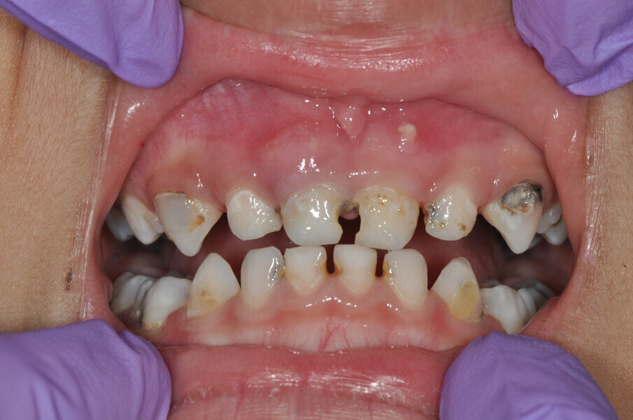 Fig.1: Caries associated with the four front teeth.